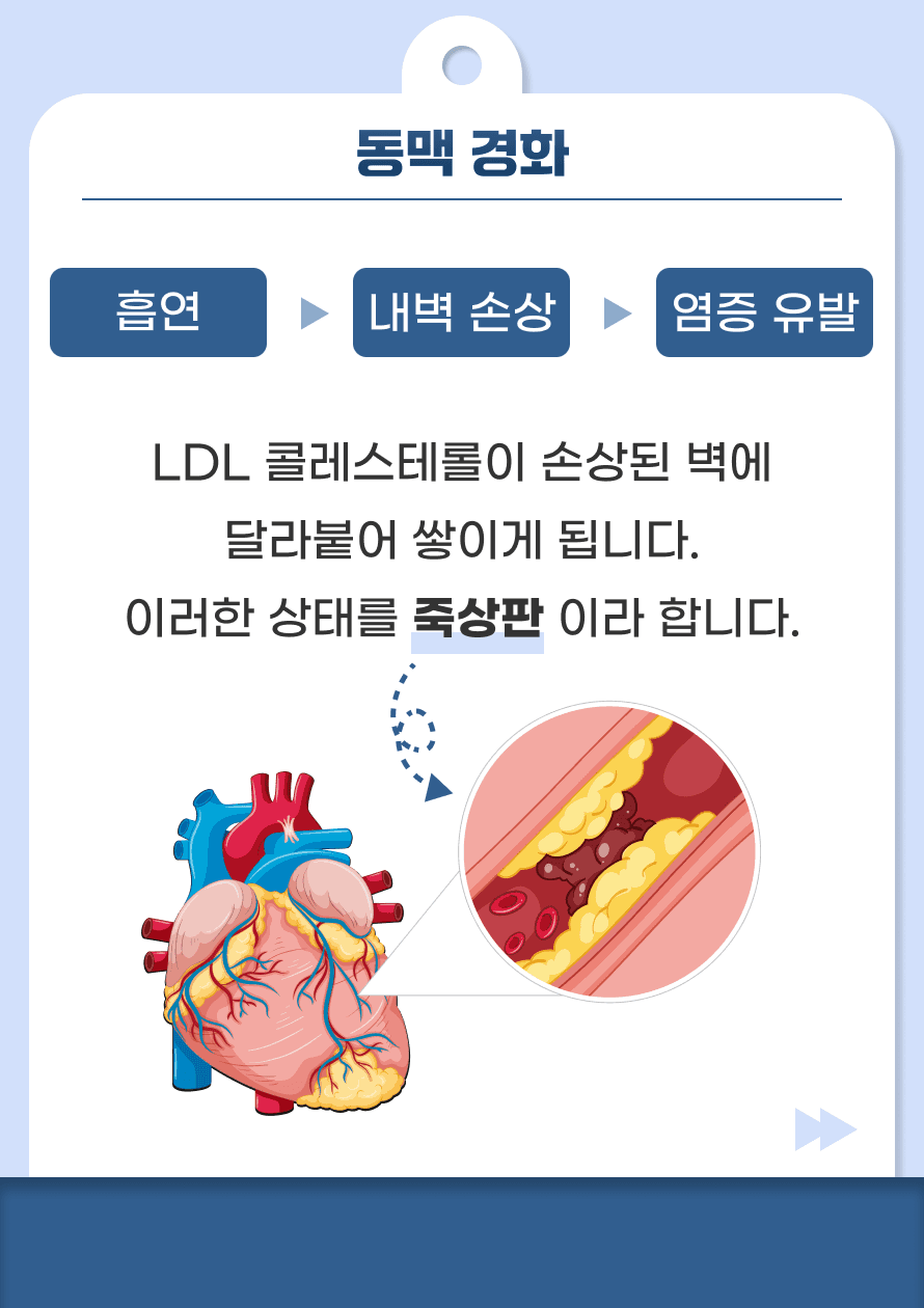 또한 흡연은 혈관이 좁고 딱딱해지는 동맥 경화를 유발합니다. 흡연 시 혈관 내벽에 손상이 발생하게 되고, 염증 반응이 유발됩니다. 이때 LDL 콜레스테롤이 손상된 벽에 달라붙어 쌓이게 됩니다. 이러한 상태를 죽상판이라 합니다.