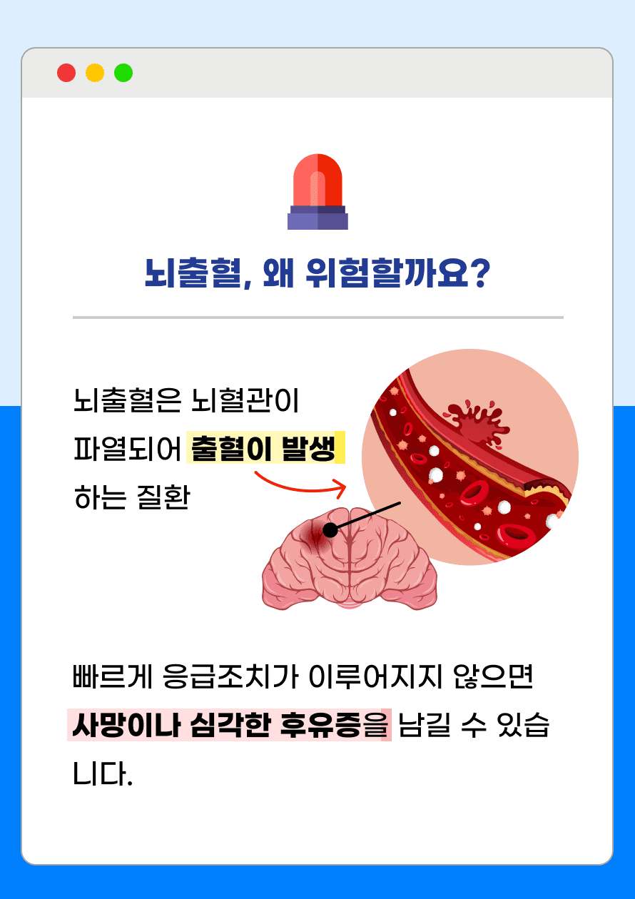 뇌출혈은 뇌혈관이 파열되어 출혈이 발생하는 질환입니다. 빠르게 응급조치가 이루어지지 않으면 사망이나 심각한 후유증을 남길 수 있습니다.