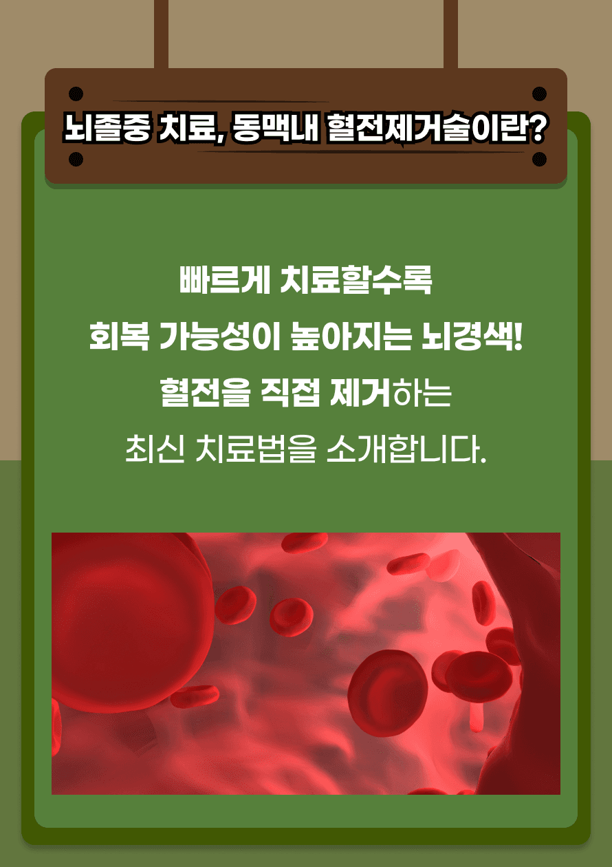 동맥내 혈전제거술은 혈관을 열어 뇌로 가는 혈류를 회복시키는 치료법입니다. 시간이 생명인 만큼, 빠른 치료가 중요합니다.
