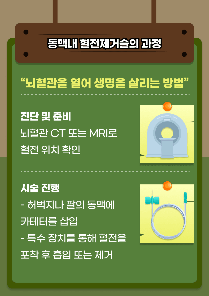혈관을 열어 혈류를 복구하는 방법, 바로 동맥내 혈전제거술입니다. 먼저 뇌혈관 상태를 CT나 MRI로 정밀하게 확인한 후, 허벅지나 팔의 동맥에 작은 카테터를 삽입합니다. 특수 장치를 이용해 혈전을 직접 제거하고, 혈류가 정상적으로 돌아오게 합니다. 이 시술은 뇌로의 혈류를 신속히 복구해 영구적인 손상을 최소화합니다.
